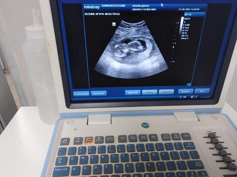 2D ultrasound scan image captured at Leanoleletle Clinic